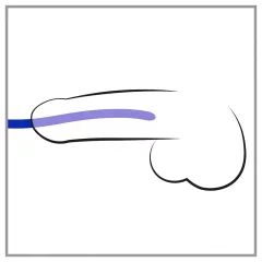   You2Toys Dilator - szilikon húgycsőtágító dilátor szett (3 db)